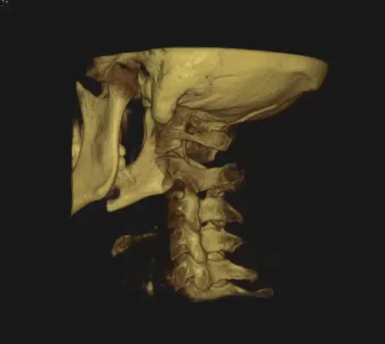 CBCT 3D cone beam scan of a patient's cervical spine, the actual imaging Dr. Walker plans each adjustment from